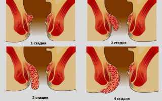 Может ли при геморрое болеть спина и низ живота