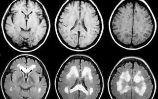 От кашля болит затылок головы что