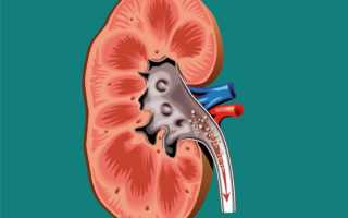 Если песок в почках может болеть спина