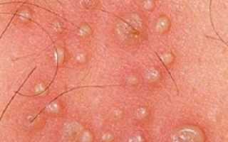 Герпес болит кожа головы