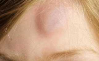 Когда трогаю шишку на голове она болит