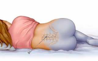 Как долго у вас болела спина после эпидуральной анестезии