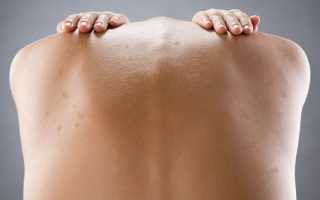 Темное пятно на спине болит