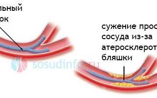 Болит голова когда сужаются сосуды головного мозга