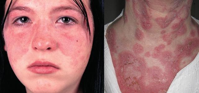 Болит голова и на лице появилась сыпь