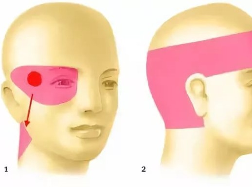 Болит один глаз и голова что делать