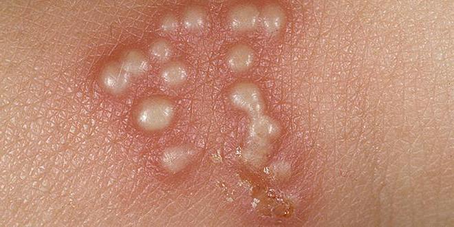 ацикловир таблетки детям отзывы