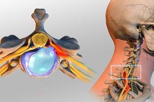 Межпозвонковая грыжа болит голова