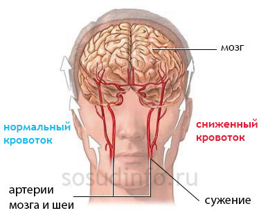 Болит голова когда сужаются сосуды головного мозга