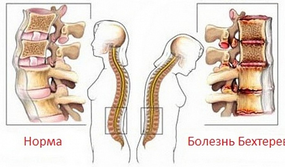 Спина устает и болит