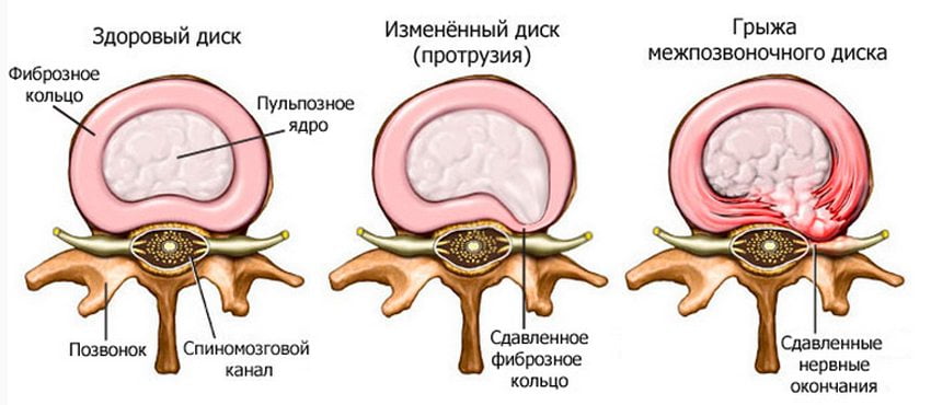 Стадии образования межпозвоночной грыжи