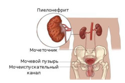 Пиелонефрит Пиелонефрит