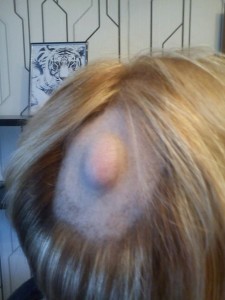 Новообразования мягких тканей и кости