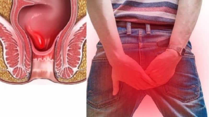 Может ли при геморрое болеть низ живота и поясница