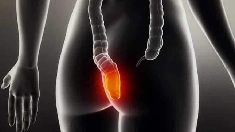 Может ли при геморрое болеть низ живота и поясница