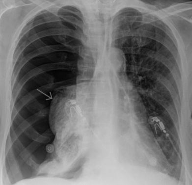 Что может болеть в правом боку отдает в спину
