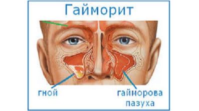 Болит спина поясница и температура что это