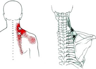 утром болит спина чуть ниже лопаток