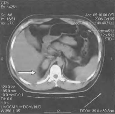 Что может болеть в правом боку отдает в спину