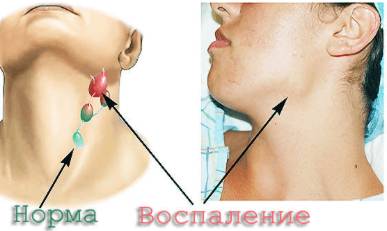 Болит спина поясница и температура что это