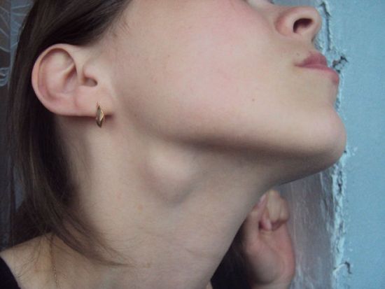 Припухлость на шее