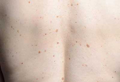 Почему может чесаться родинка