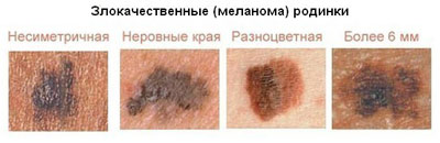 Как выглядят перерождающиеся и злокачественные родинки