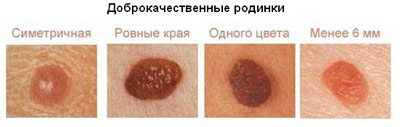 Как выглядят безопасные и доброкачественые родинки