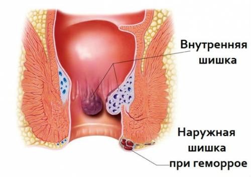 Если болит копчик когда сидишь или лежишь на спине