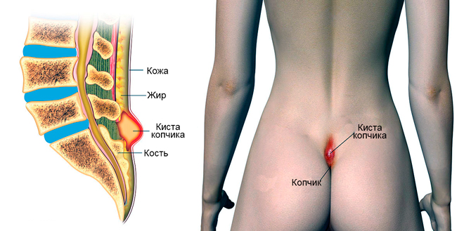 Если болит копчик когда сидишь или лежишь на спине