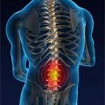 грыжа поясничного отдела