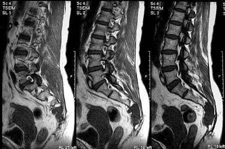 Если болит копчик когда сидишь или лежишь на спине