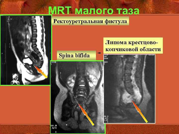 Если болит копчик когда сидишь или лежишь на спине