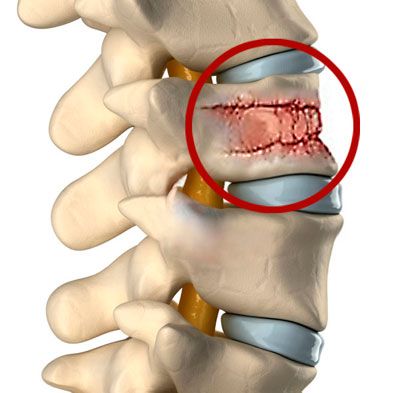 Перелом позвонка при остеопорозе
