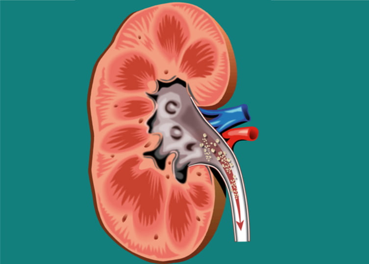 песок в почке