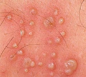 Герпес болит кожа головы