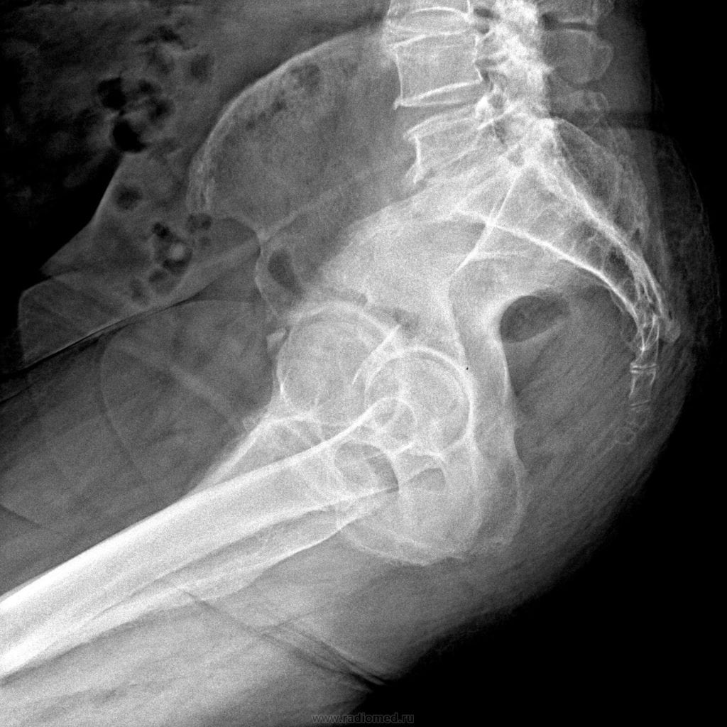 Если болит копчик когда сидишь или лежишь на спине