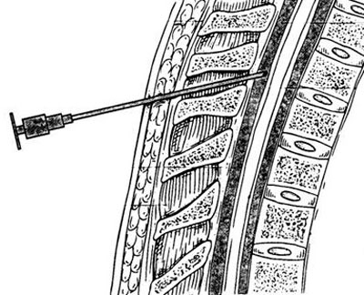 Схема вхождения иглы в позвоночник при проведении эпидуральной анестезии