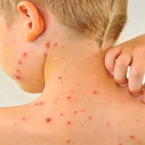 Болит голова и на лице появилась сыпь