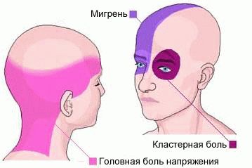 Сильно болит голова таблетки не помогают что делать